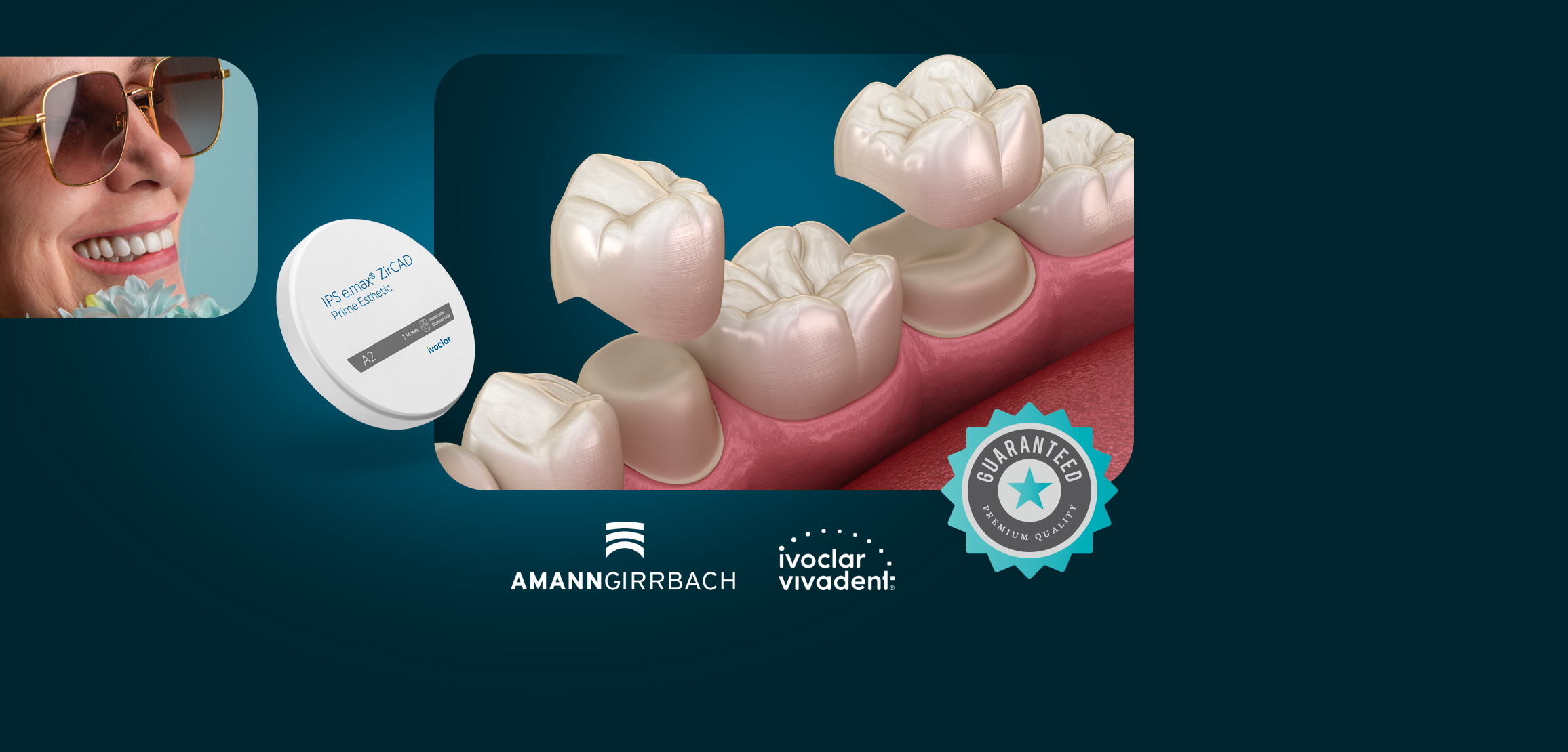 E-Max Veneers