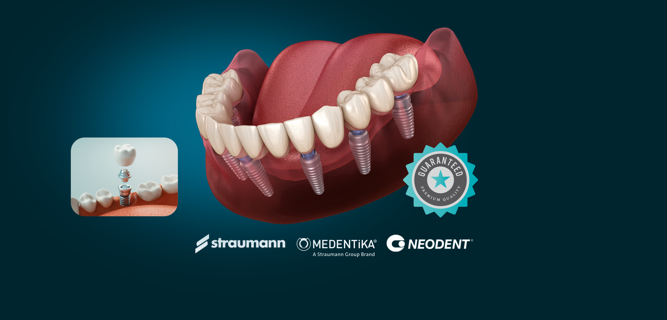 Dental Implant
